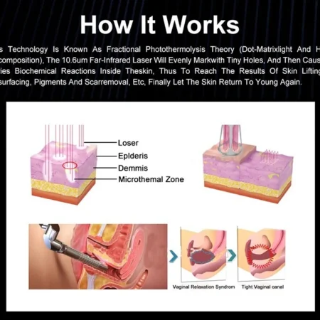 CO2 Fractional Laser Stretch Mark Acne Scar Removal Skin Resurfacing Machine